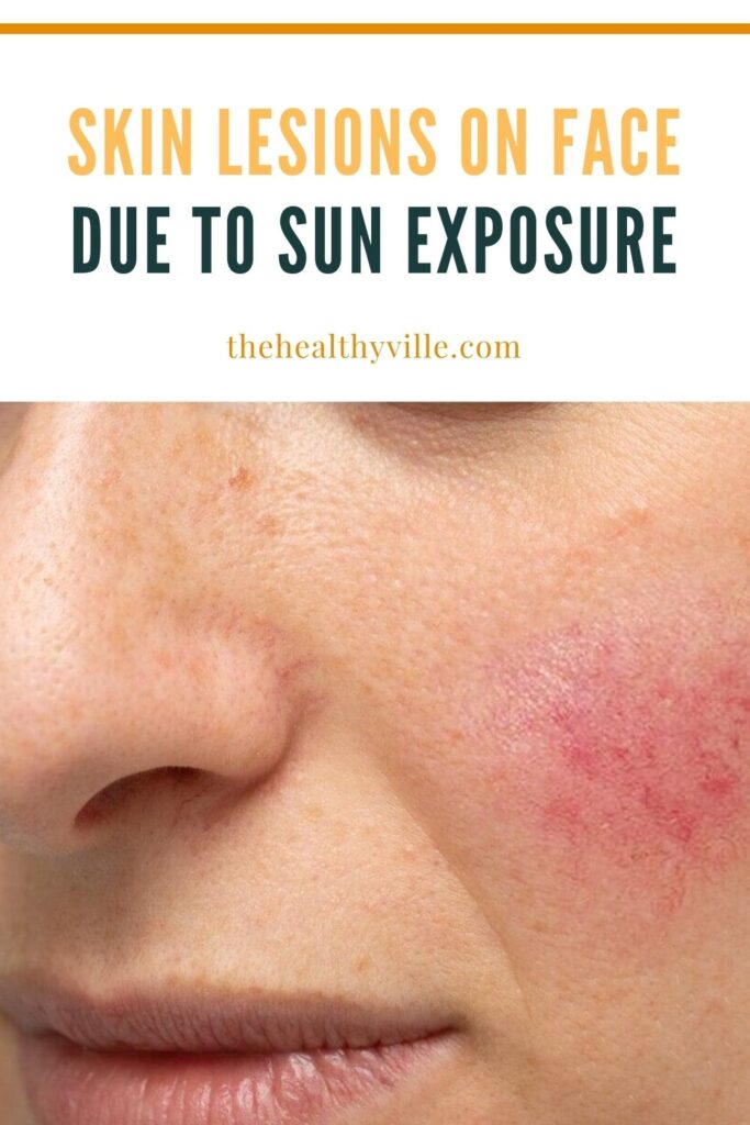 Skin Lesions on Face Due to Sun Exposure – What to Know_