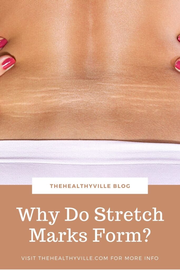 Why Do Stretch Marks Form_ Are There Different Types to Be Aware of_