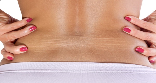 Why Do Stretch Marks Form? Are There Different Types to Be Aware of?