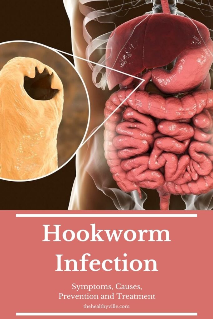 Hookworm Infection – Symptoms, Causes, Prevention and Treatment