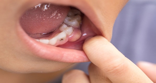 dental infection symptoms