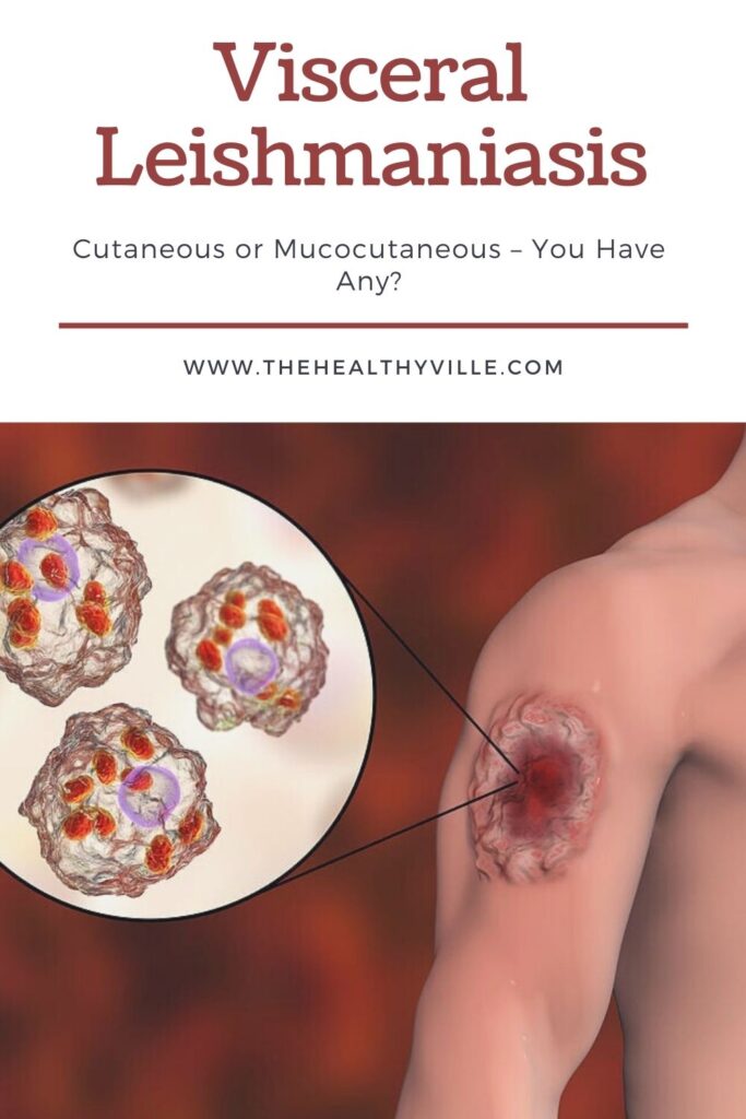 Visceral Leishmaniasis, Cutaneous or Mucocutaneous – You Have Any_