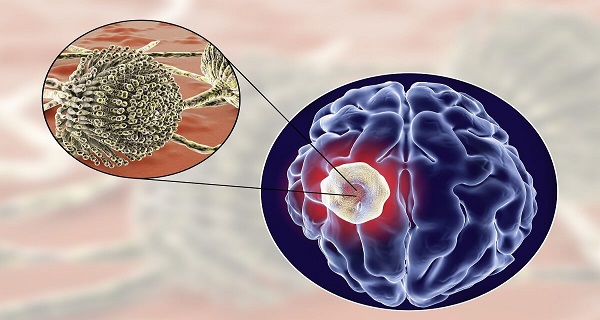 Brain Abscess Signs And Symptoms