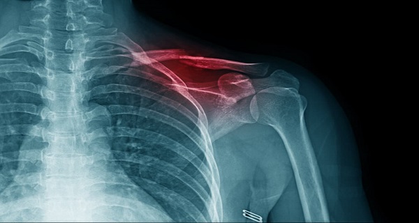 clavicle fracture treatment