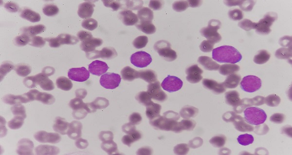 hairy cell leukemia symptoms