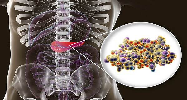 tumor on pancreas