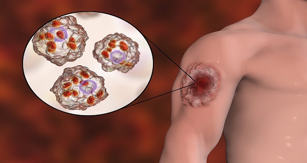 visceral leishmaniasis