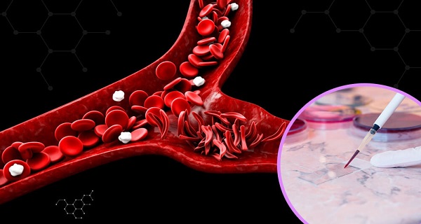 is sickle cell anemia genetic