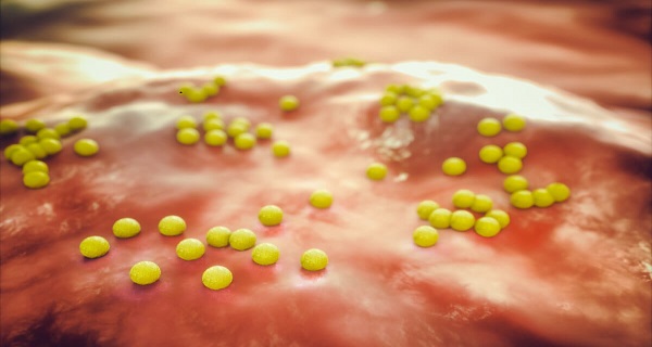 signs and symptoms of MRSA