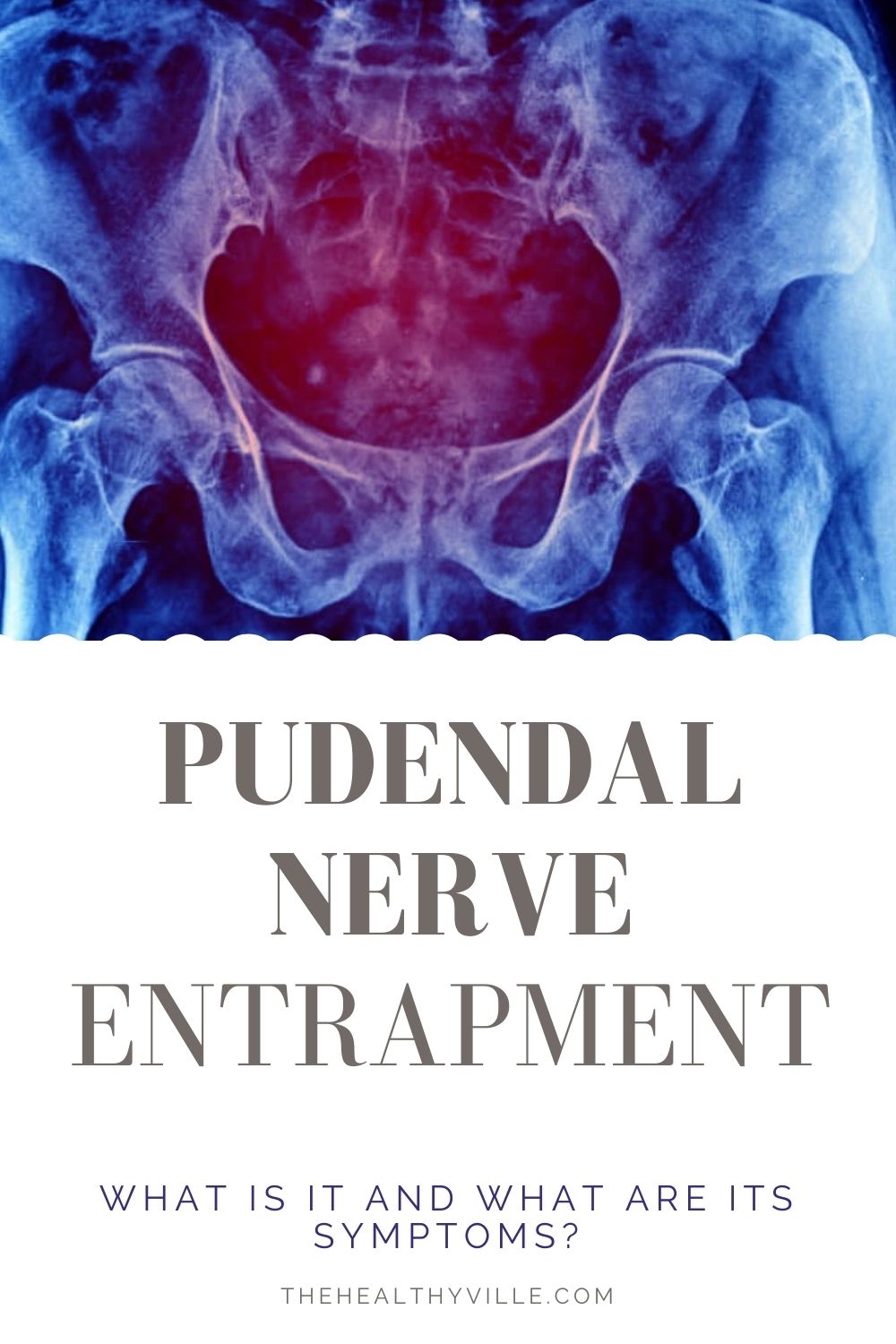 photo-of-pudendal-entrapment-location-and-symptoms-nerve-injury-my