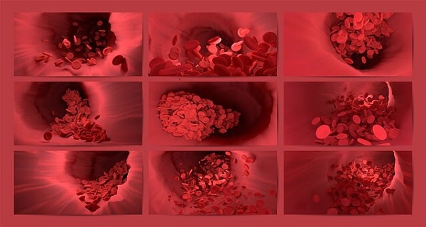 fibrinolysis definition