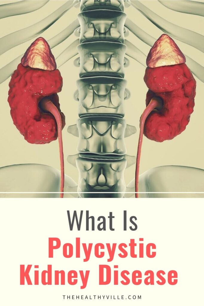 What Is Polycystic Kidney Disease - Symptoms and Treatment