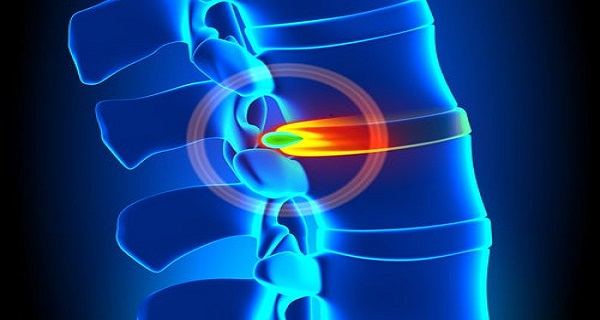 how to treat herniated disc