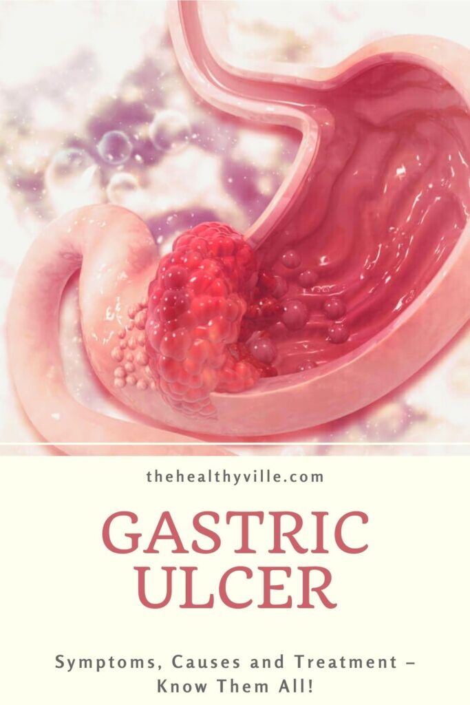 Gastric Ulcer Symptoms, Causes and Treatment – Know Them All!