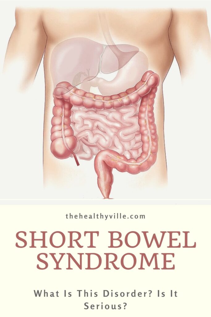 Short Bowel Syndrome – What Is This Disorder Is It Serious