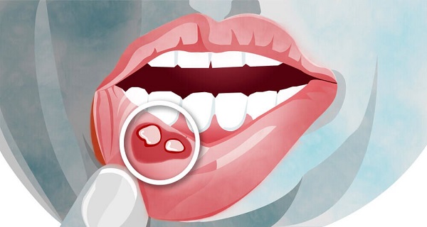 canker sore treatment