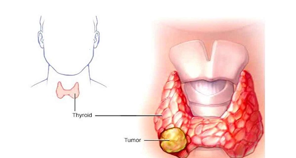 lump on thyroid