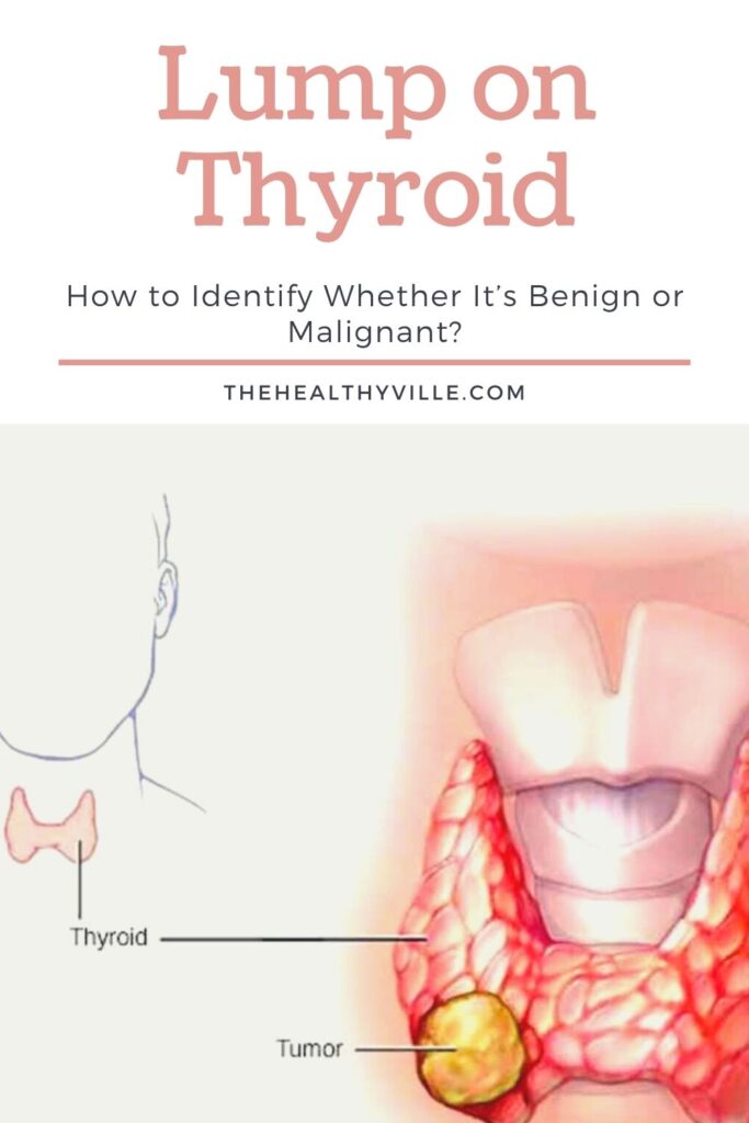 Lump on Thyroid – How to Identify Whether It’s Benign or Malignant