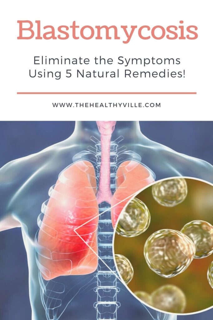 Blastomycosis – Eliminate the Symptoms Using 5 Natural Remedies!