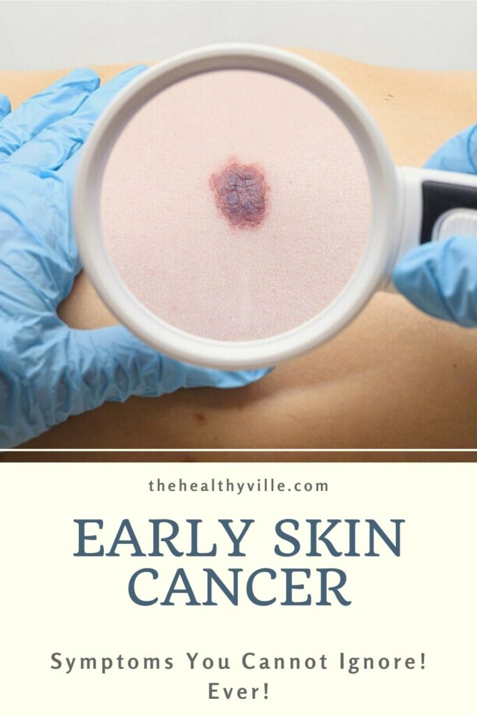 Early Skin Cancer Symptoms You Cannot Ignore! Ever!