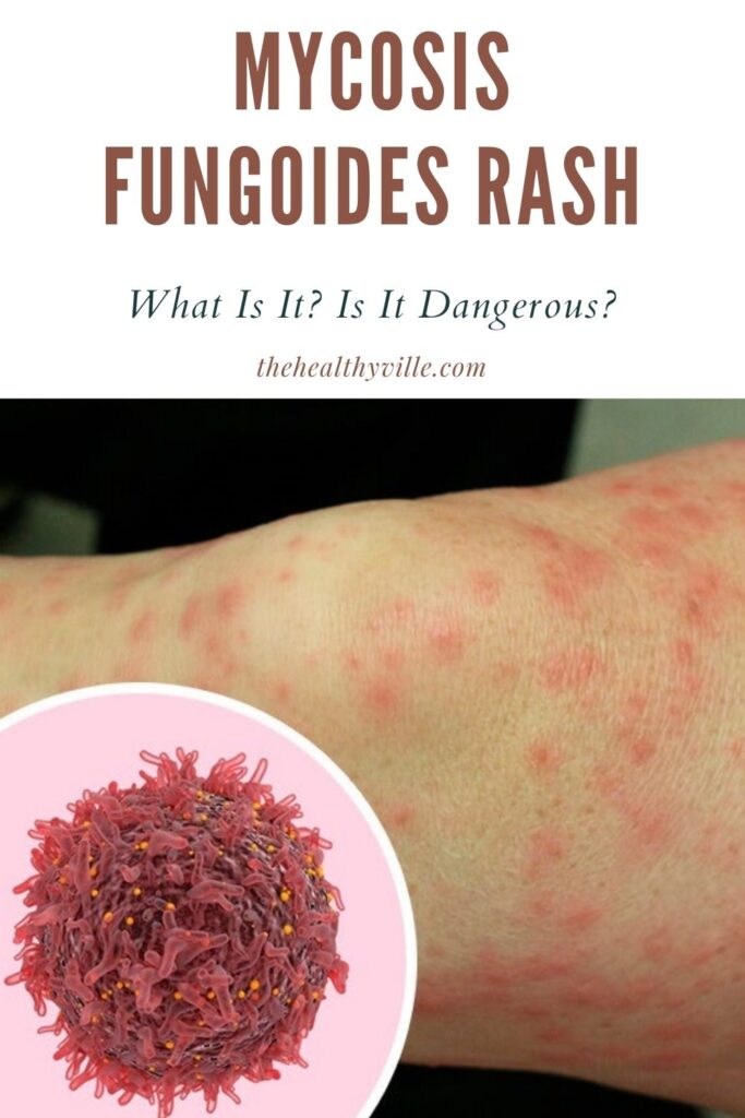 Mycosis Fungoides Rash – What Is It Is It Dangerous