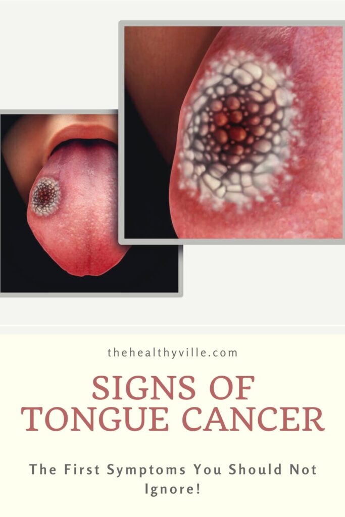Signs of Tongue Cancer – The First Symptoms You Should Not Ignore!