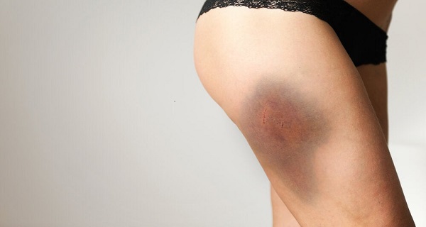 how to get a bruise to heal