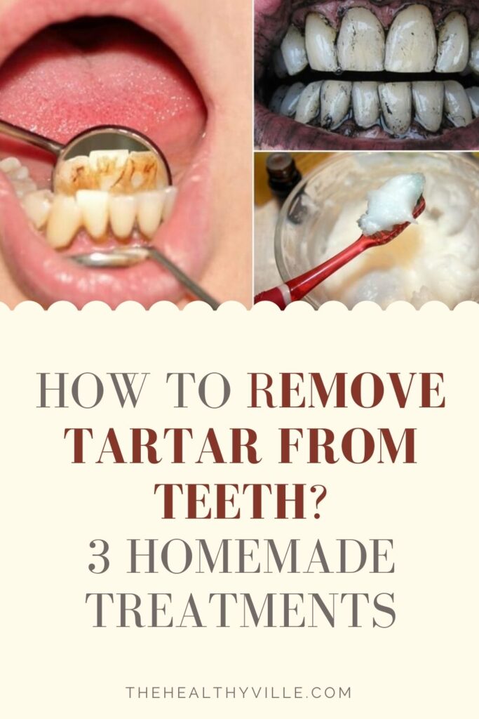 How to Remove Tartar from Teeth – 3 Homemade Treatments