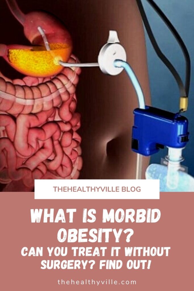 What Is Morbid Obesity Can You Treat It without Surgery Find Out!