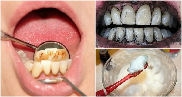 how to remove tartar from teeth