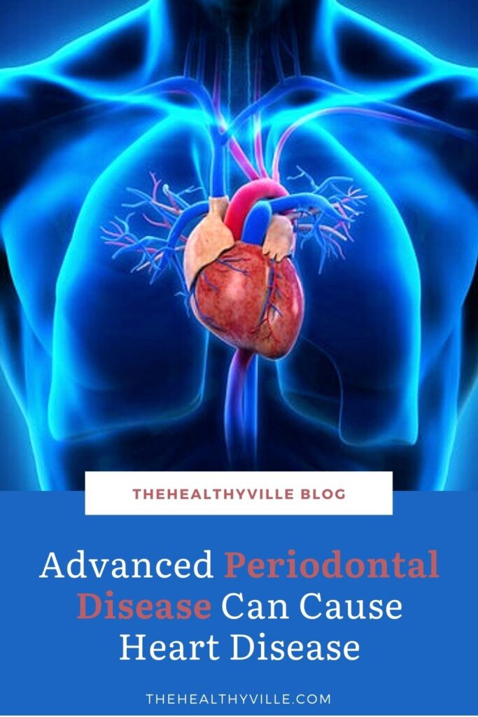 Advanced Periodontal Disease Can Cause Heart Disease – There’s a Link!