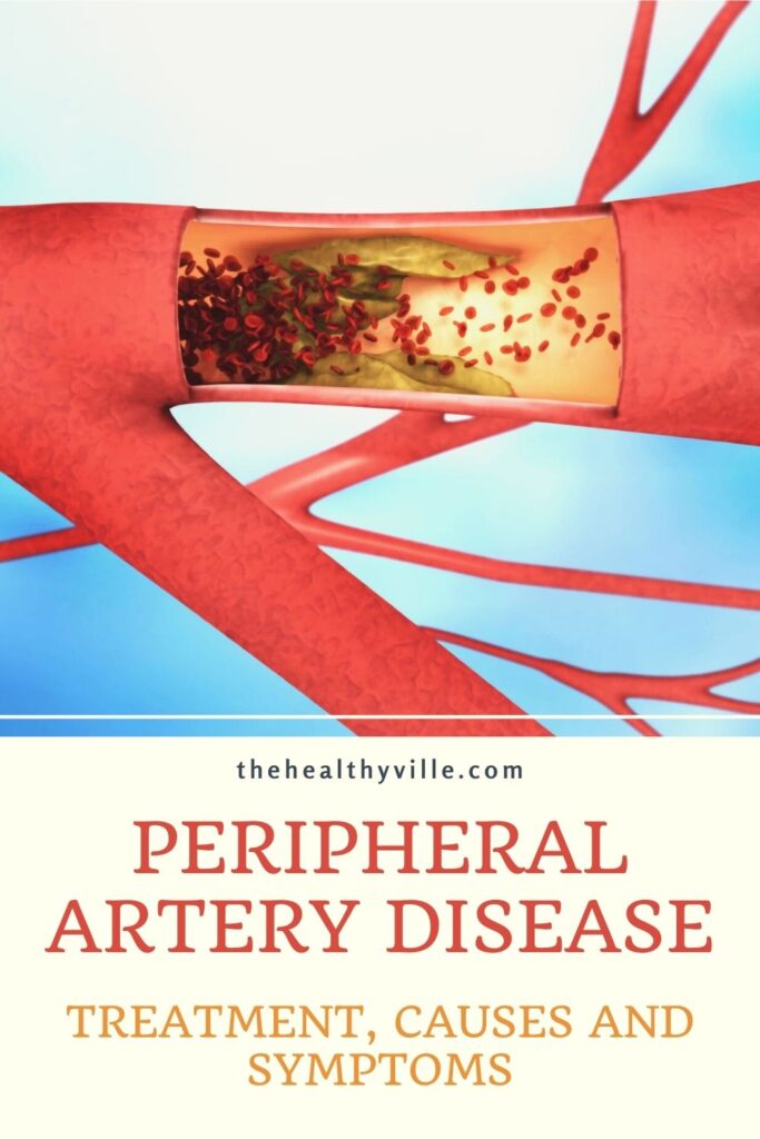 Peripheral Artery Disease Treatment, Causes and Symptoms