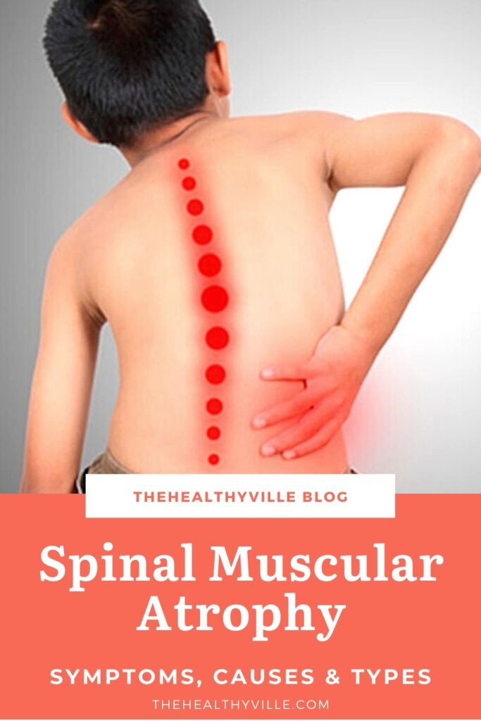 Spinal Muscular Atrophy Symptoms, Causes & Types – Everything to Know