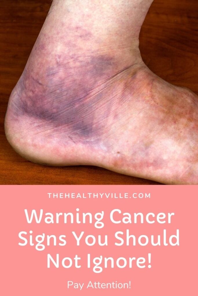 Warning Cancer Signs You Should Not Ignore! – Pay Attention!