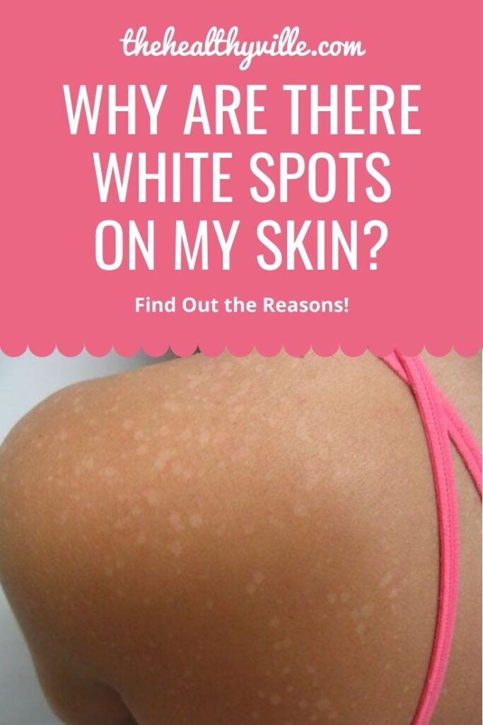 Why Are There White Spots on My Skin – Find Out the Reasons!