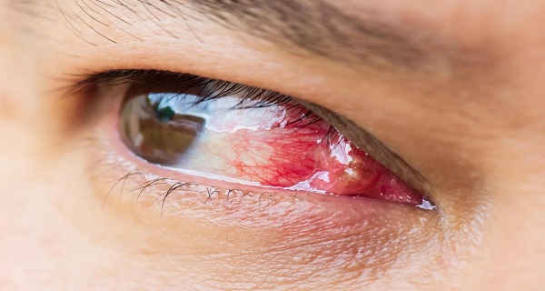 Pterygium – What Is It and Why Do You Need to Know About It?