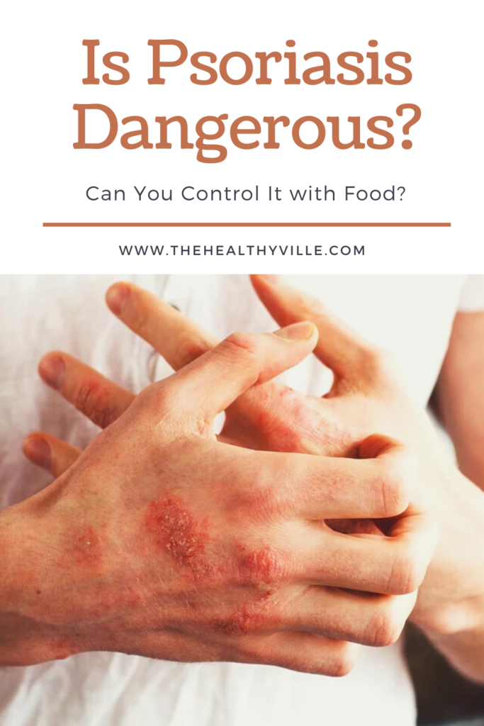 Is Psoriasis Dangerous Can You Control It with Food