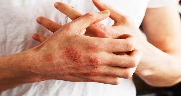 Is Psoriasis Dangerous? Can You Control It with Food?