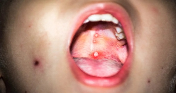 Gingivostomatitis: Why Does It Appear and How to Treat It?