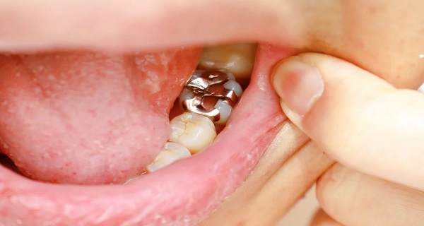 Resin Based Composite or Amalgam – Which One Is Better and Safer?
