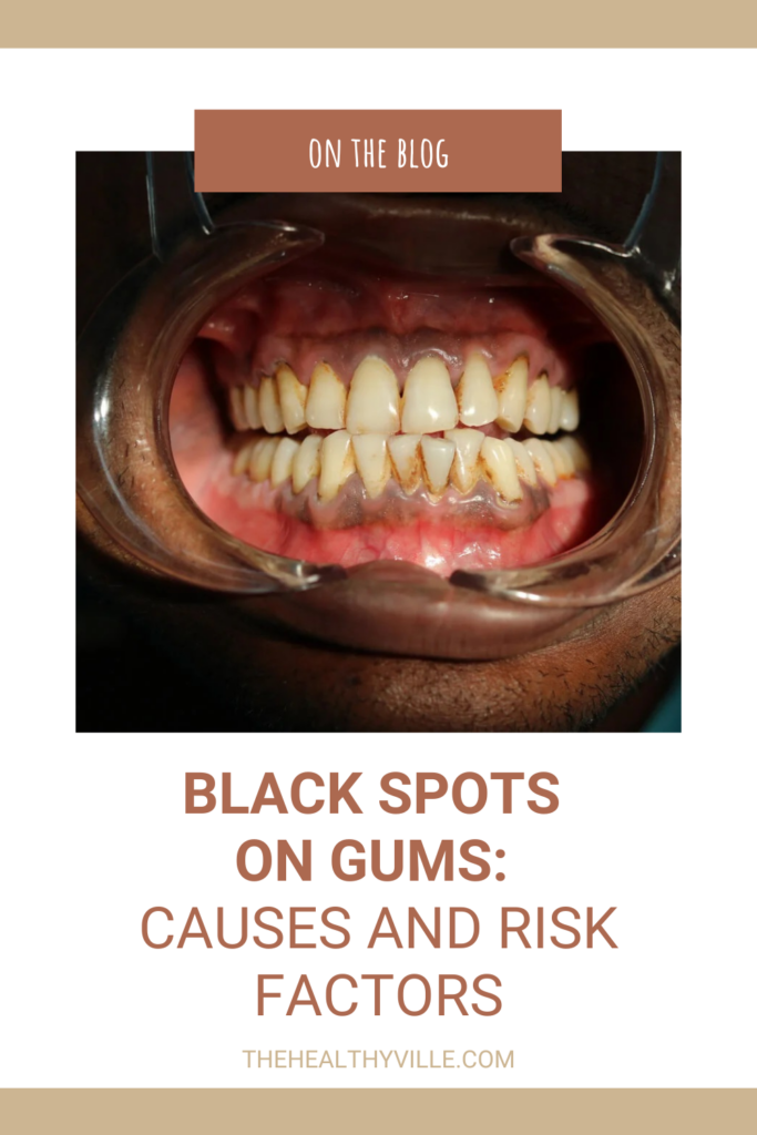 Black Spots on Gums Causes and Risk Factors