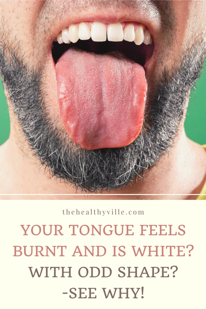 Your Tongue Feels Burnt and Is White With Odd Shape