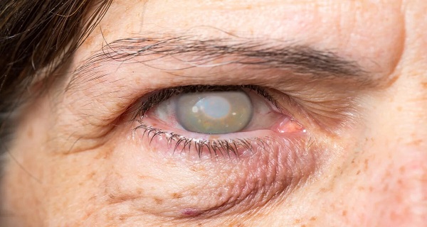 are cataracts genetic